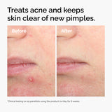 Salicylic Acid 2% Solution