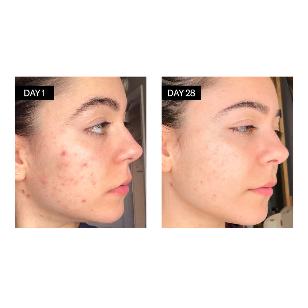 BL+C Pimples | Black Cumin + Cajeput Serum Concentrate