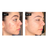 BL+C Pimples | Black Cumin + Cajeput Serum Concentrate